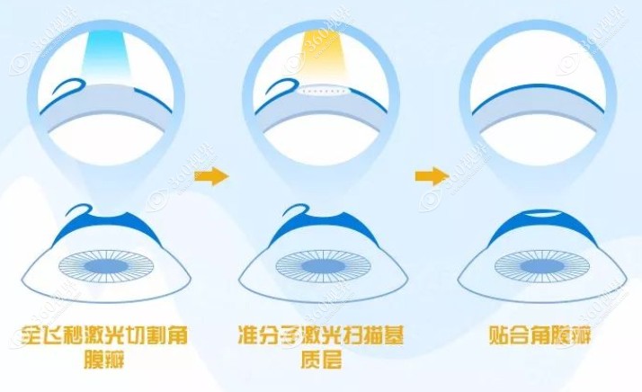 半飞秒激光手术过程