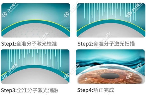 ek近视激光手术过程360tulou.com
