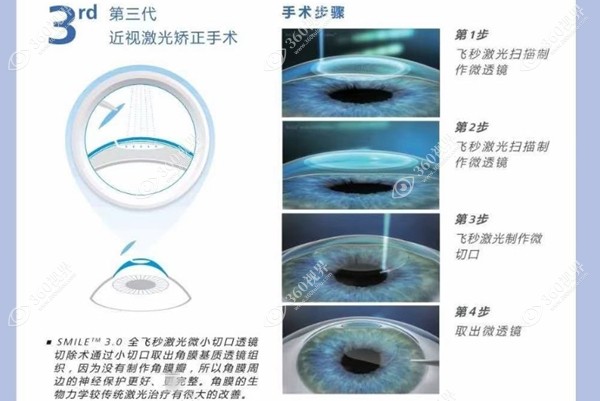 全飞秒手术过程图