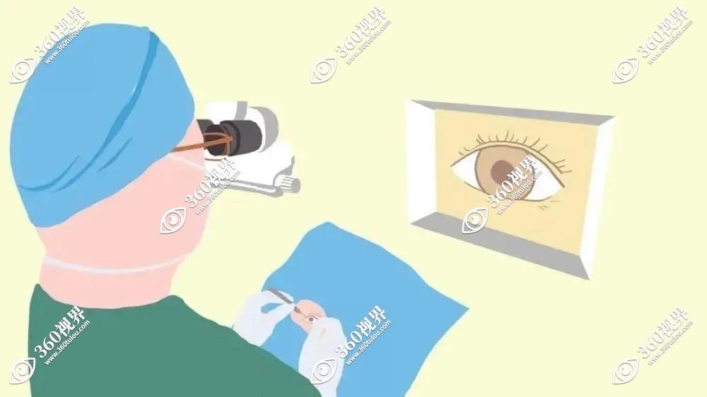 晶体植入眼内镜手术