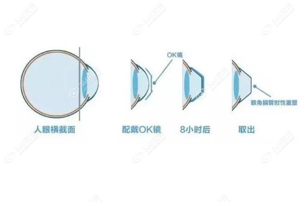 OK镜矫正近视原理