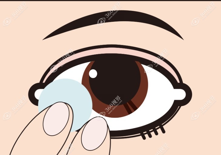 OK镜能矫正近视吗