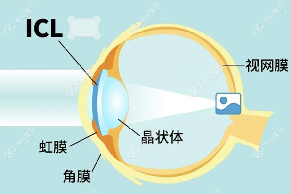 人工晶体植入过程