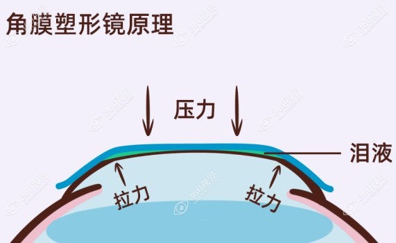 国产角膜塑形镜的价格一般是多少