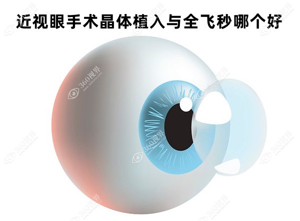 近视眼手术晶体植入与全飞秒哪个好