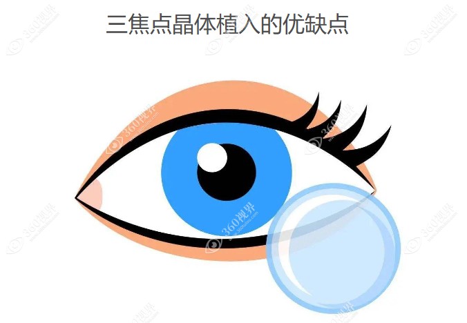 三焦点晶体植入的优缺点