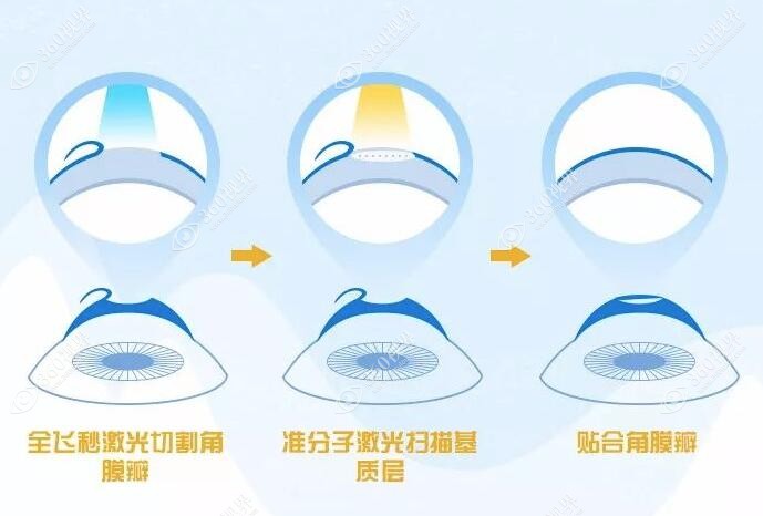 全飞秒近视手术