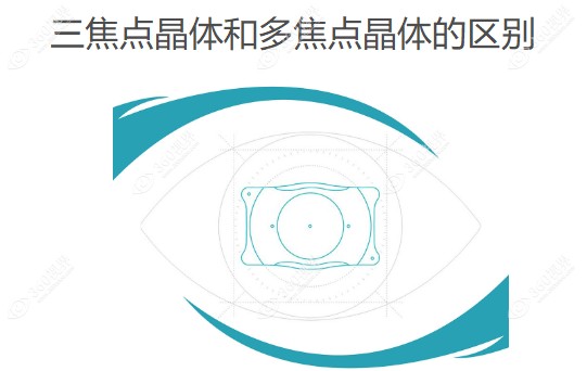 三焦点晶体和多焦点晶体的区别