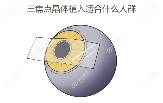 三焦点晶体植入适合什么人群
