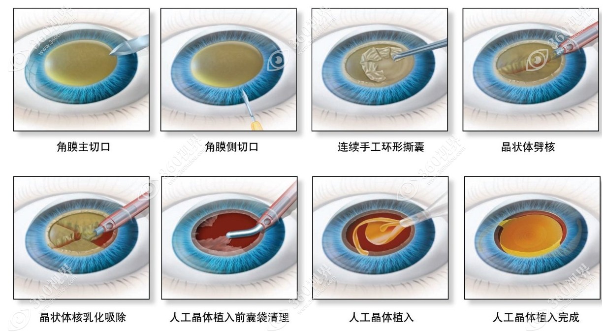 传统白内障超声乳化手术过程和步骤