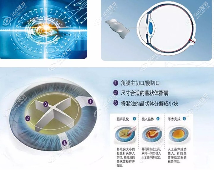 飞秒激光白内障手术多少钱一次