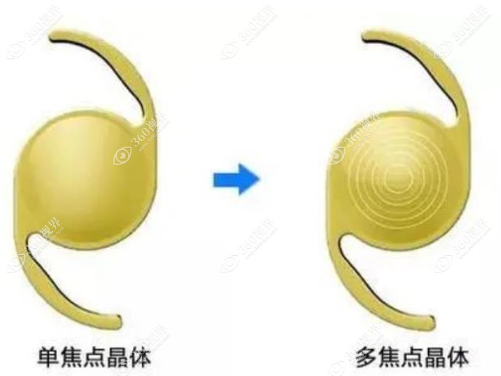 医生不推荐多焦人工晶体原因