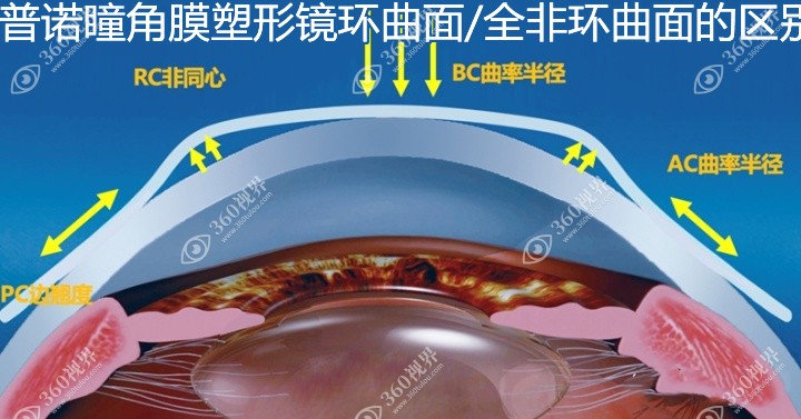 普诺瞳角膜塑形镜环曲面/全非环曲面的区别