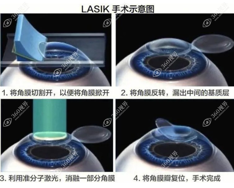 飞秒激光手术，也称LASIK手术