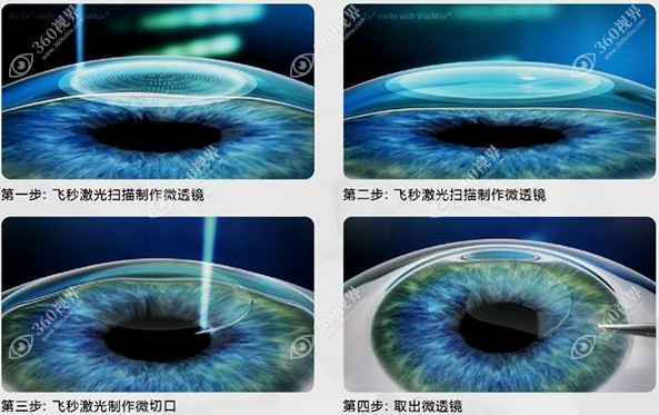 全飞秒近视手术过程