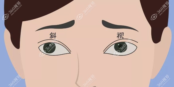 眼睛斜视手术费用得多少钱www.360tulou.com
