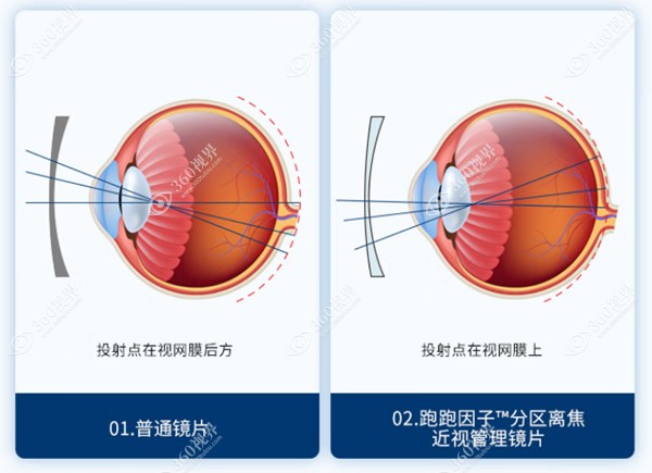 多焦点近视离焦镜片原理 360tulou.com
