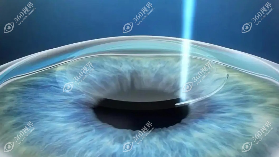 先天性近视1000多度可以手术吗