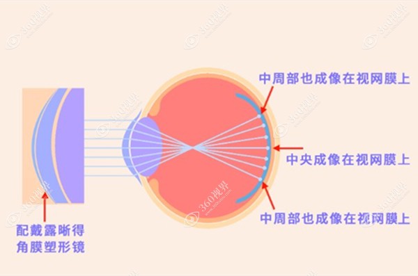 角膜塑形镜的矫正范围