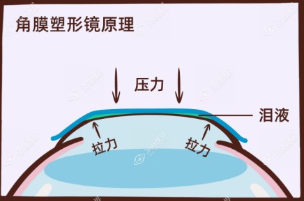 戴8年角膜塑形镜的体会和感受:两年涨了100度感觉还是蛮值的