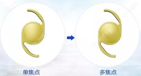三焦人工晶体价格贵