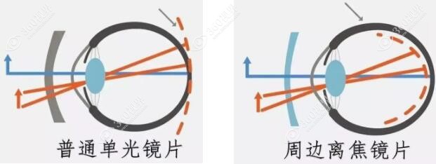 控制孩子近视眼睛度数增长的有效方法