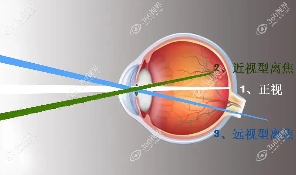 控制孩子近视眼睛度数增长的有效方法