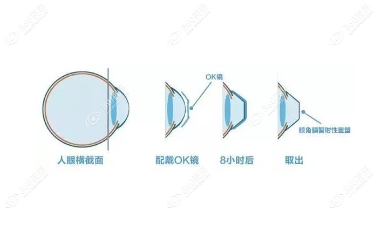 角膜塑形镜
