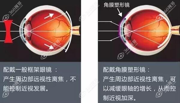 控制孩子近视眼睛度数增长的有效方法