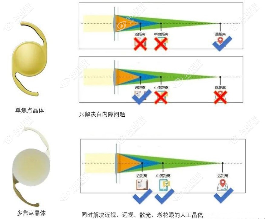 白内障单焦点晶体和多焦点晶体区别