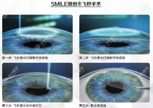 德国蔡司全飞秒激光近视手术的缺点360tulou.com