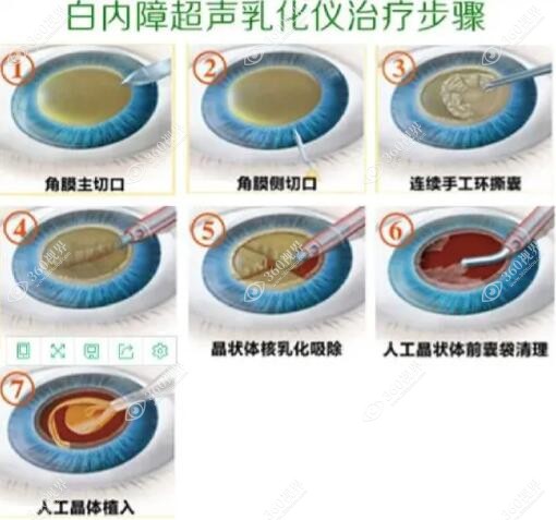 白内障超声乳化手术步骤www.360tulou.com