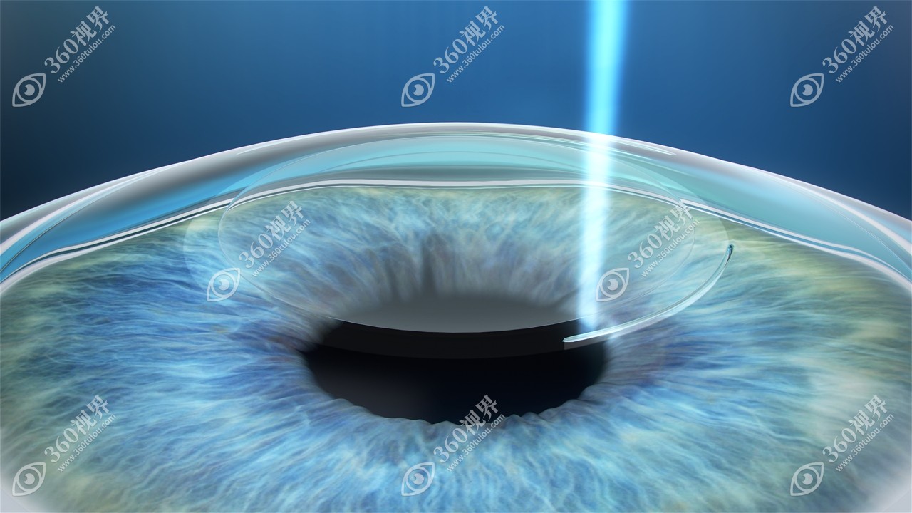 近视眼手术结构示意图