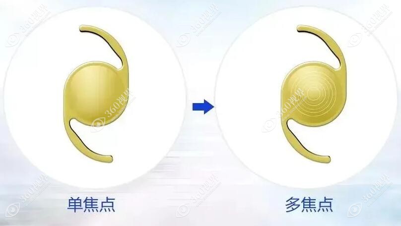 关于白内障手术费报销的友情提示