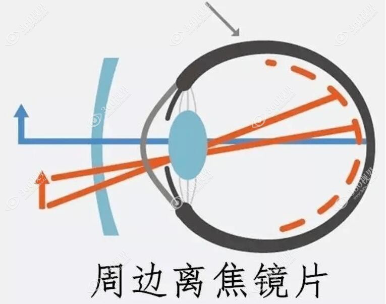 离焦眼镜原理图