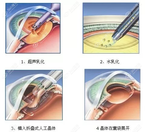 70-90岁老年人有必要做白内障手术