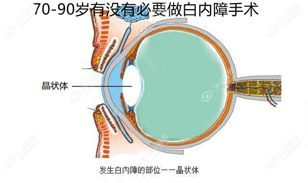 70-90岁有没有必要做白内障手术?有必要,可有效恢复眼睛视力