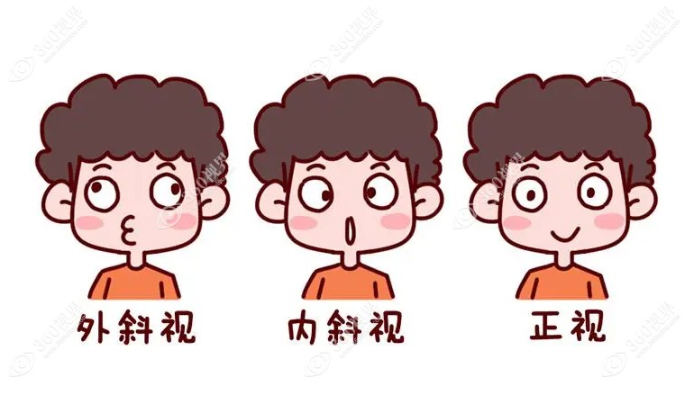 斜视手术恢复期需要注意什么www.360tulou.com