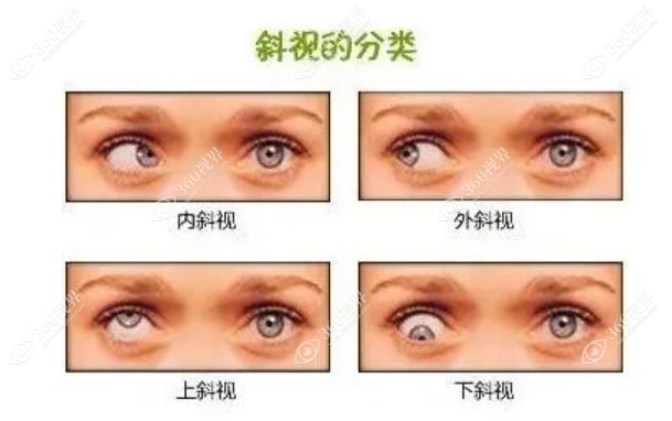 斜视手术恢复期需要注意什么