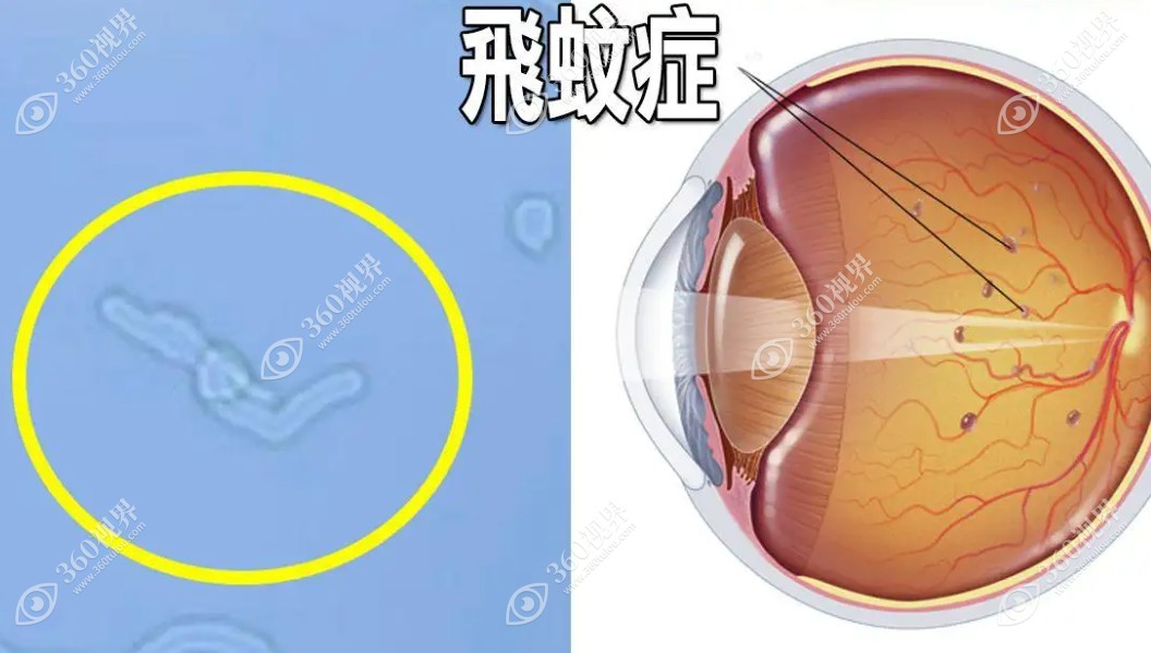 高度近视引起的飞蚊症是生理还是病理