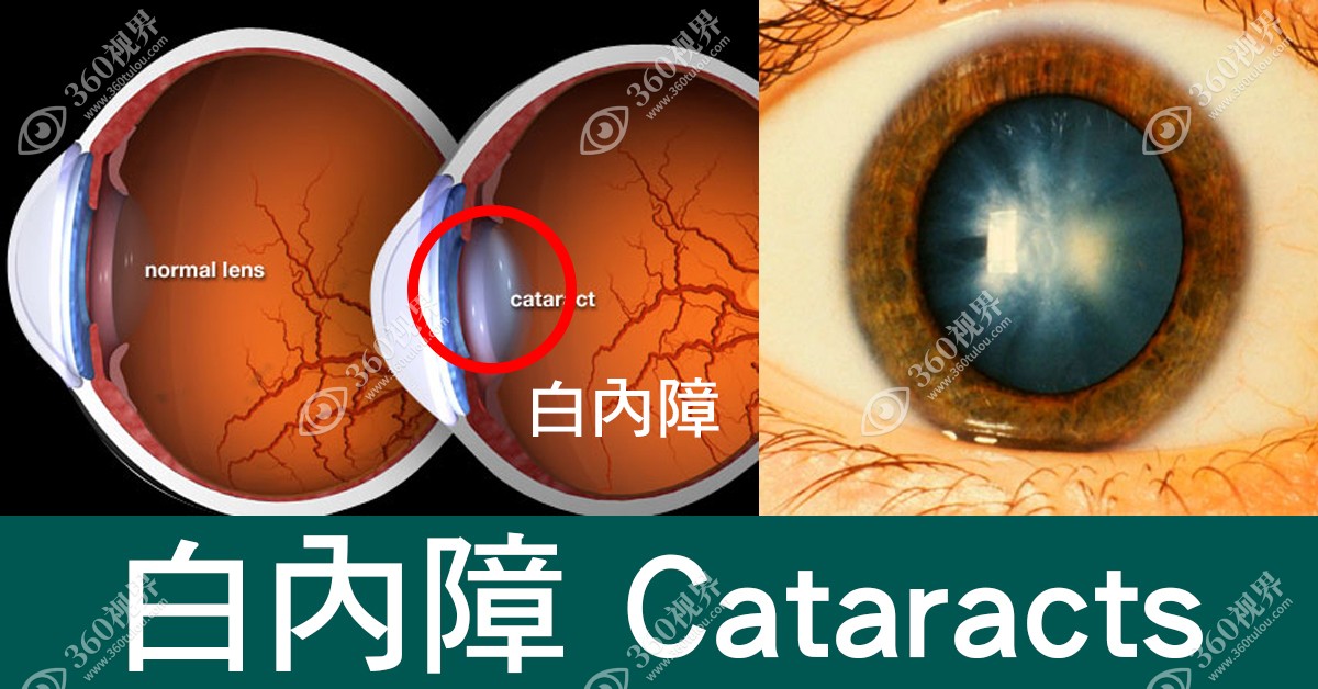 免费白内障手术可靠吗
