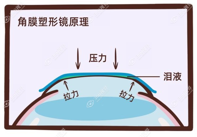 角膜塑形镜原理