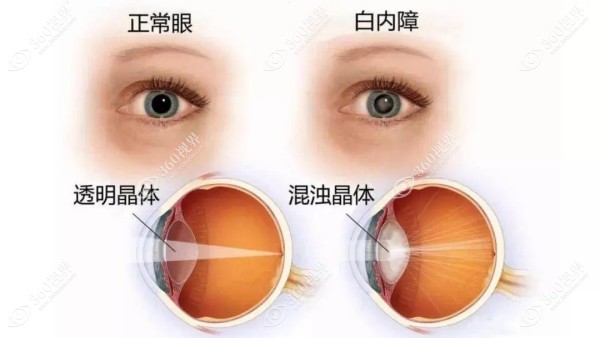 白内障手术是置换晶体