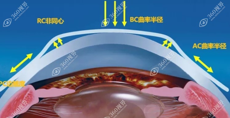 角膜塑形镜塑形原理示意图