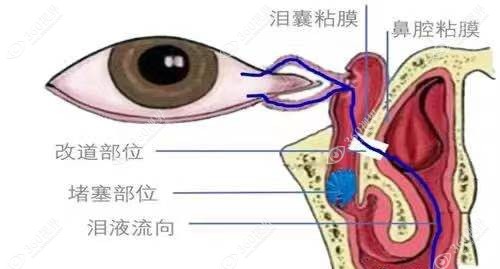 成人眼睛泪道堵塞小妙招360tulou.com