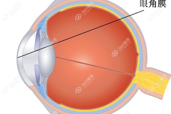 圆锥角膜初期怎么治疗角膜交联术