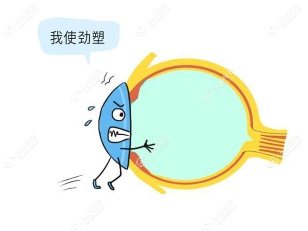 离焦软镜和ok镜（角膜塑形镜）区别在于镜片原理不同