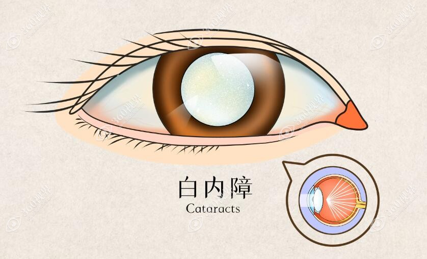 白内障症状360tulou.com