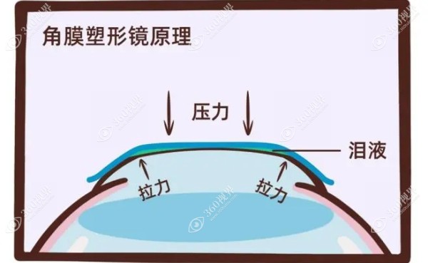 角膜塑形镜性价比品牌