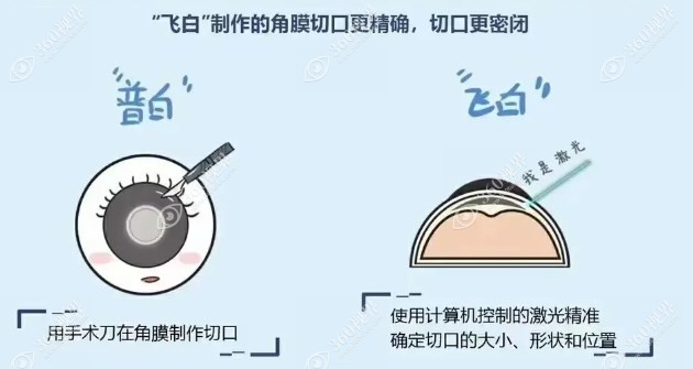 白内障飞秒激光手术与超声乳化